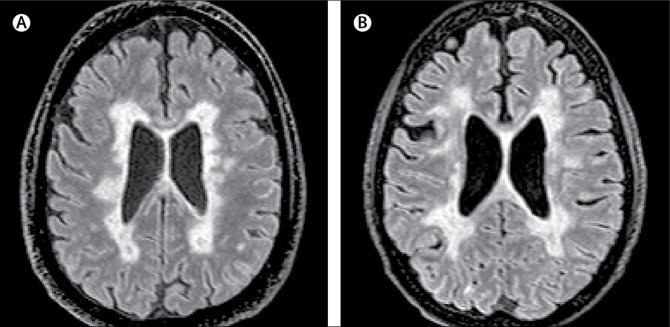 Mynd af segulómun (MRI) af heila MCMS-einstaklings og heila einstaklings með dæmigerðan MS.